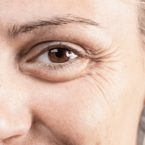 Tränensäcke entfernen mit und ohne OP in Düsseldorf