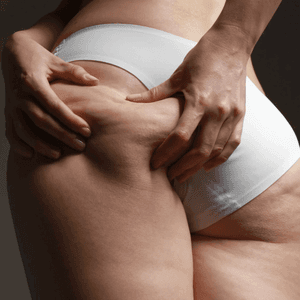 Cellulite Behandlung - Cellulite entfernen lassen ohne Operation