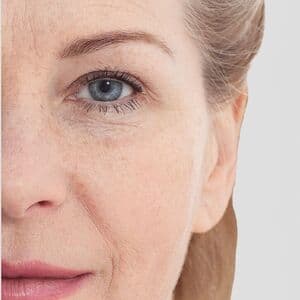 Radiesse® oder Sculptra®?