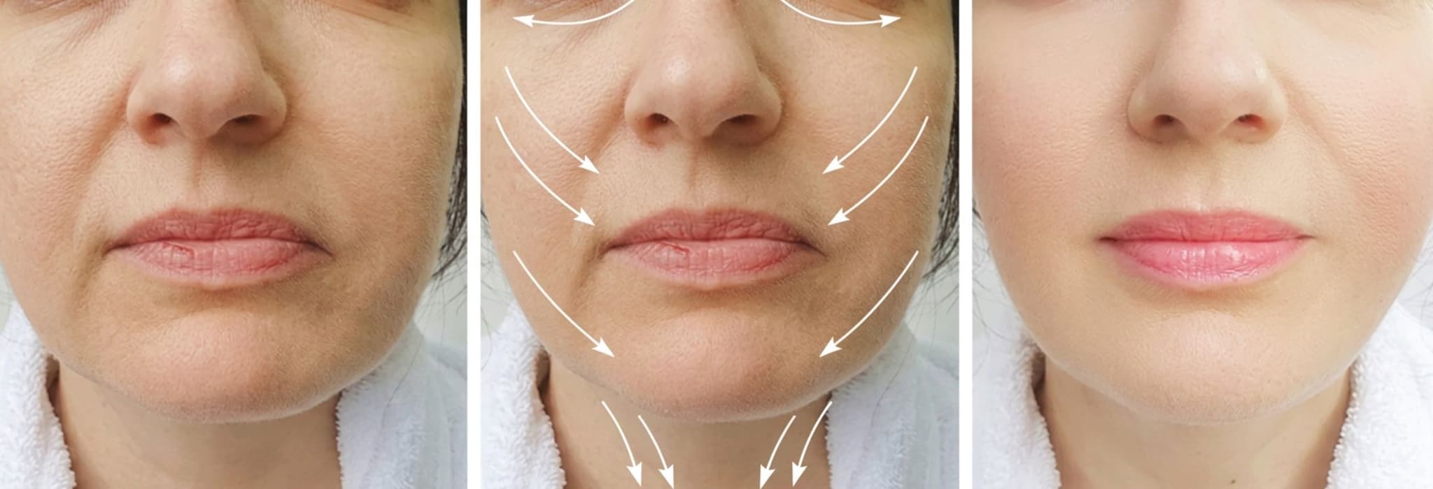 Kris Jenner und das „verrutschte" Facelift: Was ein Facelift wirklich kann