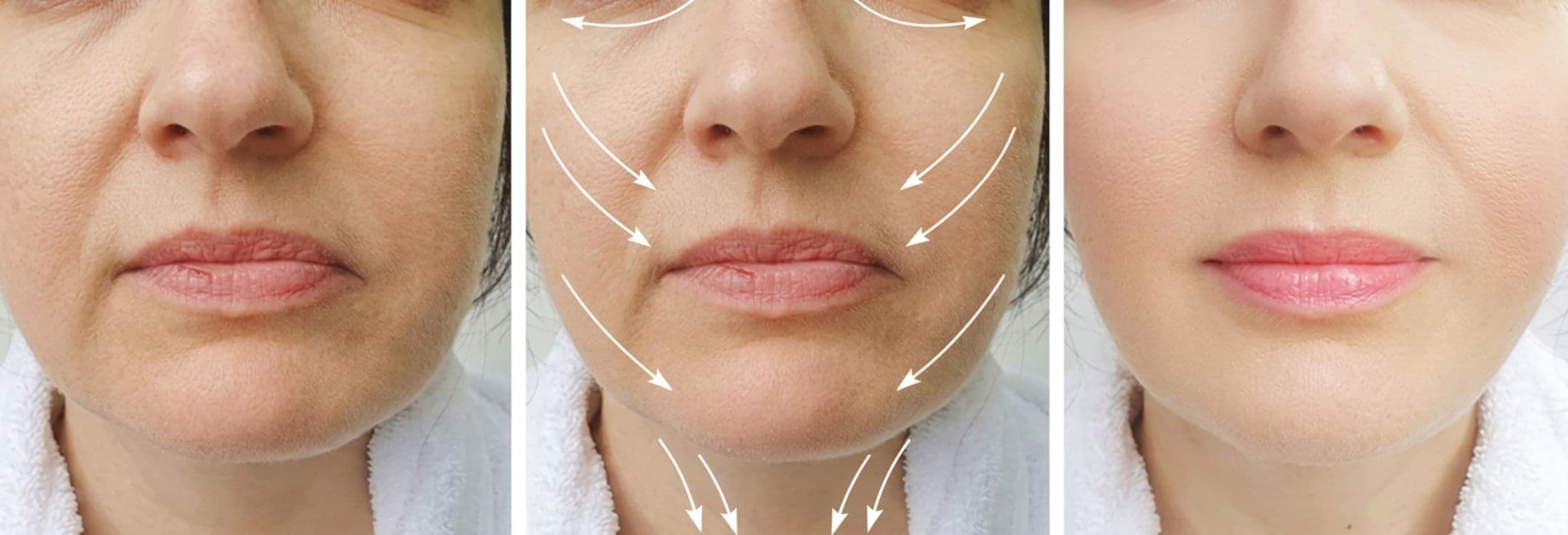 Kris Jenner und das „verrutschte" Facelift: Was ein Facelift wirklich kann