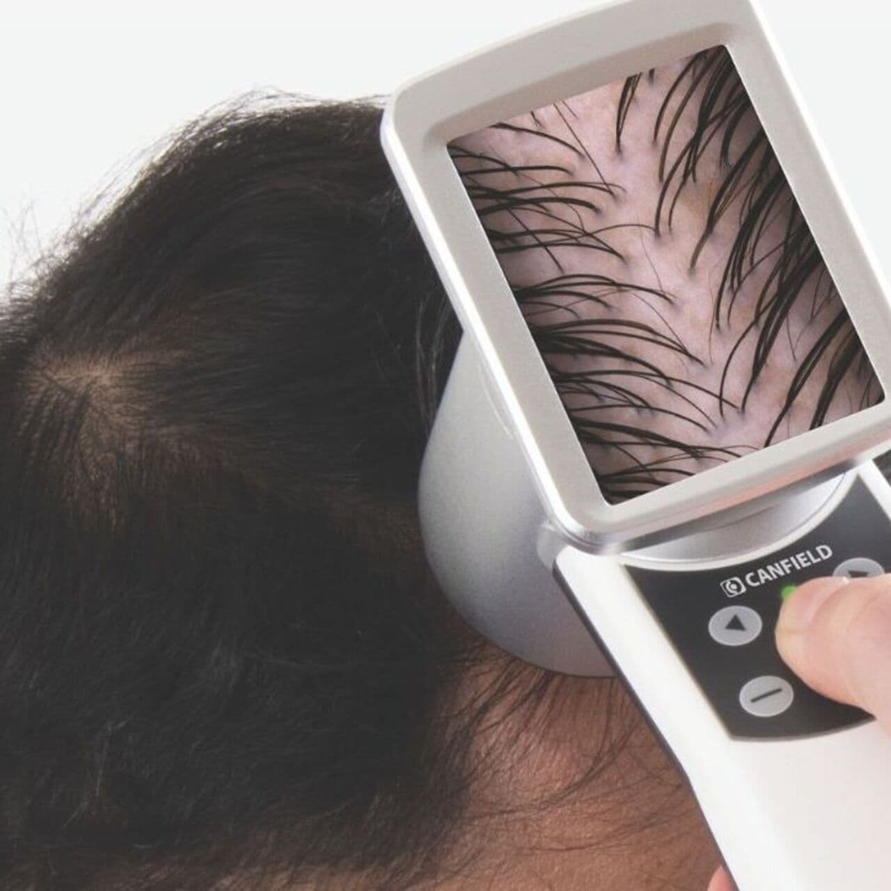 PRP + Polynukleotide