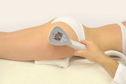 Cellulitebehandlung mit dem Exilis-Elite System – Cellulitebehandlung Düsseldorf